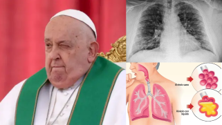 Papa Francisco; imagen ilustrativa de radiología de Neumonía bilateral y gráfico