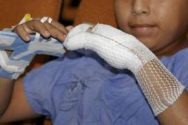 Las quemaduras de segundo y tercer grado figuran entre las principales causas de atención médica durante las fiestas de fin de año.