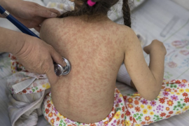 El sarampión es una enfermedad viral altamente contagiosa.