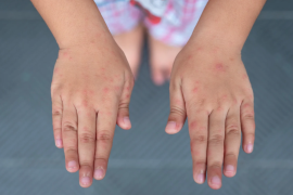 En lo que va del año se registran siete brotes; se aplican medidas preventivas por aula y no se cierran escuelas