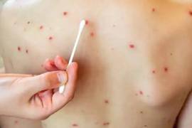 La Secretaría de Salud del Estado de Durango activó una alerta epidemiológica tras la confirmación de 17 contagios de sarampión, e intensificó las acciones preventivas para evitar la propagación del virus.