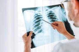 La tuberculosis es una enfermedad pulmonar que conlleva importantes riesgos.