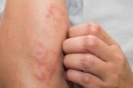 9 estados concentran incidencia de lepra en México