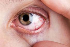 El 50% de personas que padecen glaucoma no lo saben