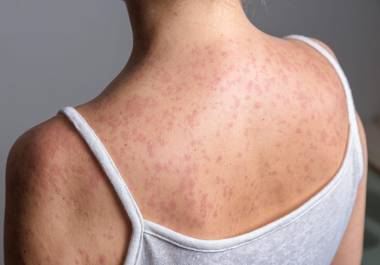 La Secretaría de Salud exhortó a niños y adultos menores de 49 años a completar su esquema de vacunación gratuita ante el repunte de sarampión.