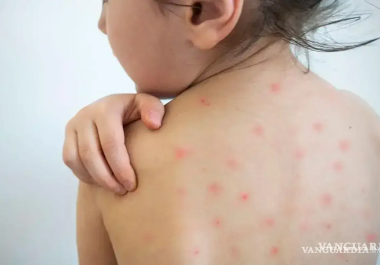 La Secretaría de Salud (SS) de México confirmó otro caso positivo de sarampión en Nuevo León, sumando tres personas con el diagnóstico y cinco en lo que va del 2025 al 2026.