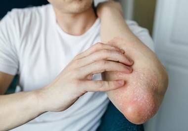 El superhongo Trichophyton indotineae aumenta 500% en el Reino Unido. Conoce cómo se contagia, cómo afecta a los pacientes y por qué preocupa a especialistas en salud pública.