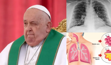 Papa Francisco; imagen ilustrativa de radiología de Neumonía bilateral y gráfico