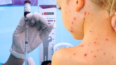 Mientras México se prepara para recibir la Copa del Mundo 2026, el resurgimiento del sarampión pone en duda la seguridad sanitaria de millones de aficionados y el estatus de eliminación de la enfermedad en el país.