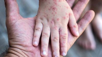 Se mantienen en vigilancia 156 casos sospechosos.