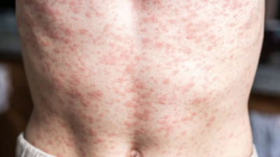 El brote de sarampión en México mantiene en alerta a las autoridades sanitarias.