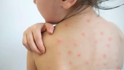 La Secretaría de Salud (SS) de México confirmó otro caso positivo de sarampión en Nuevo León, sumando tres personas con el diagnóstico y cinco en lo que va del 2025 al 2026.