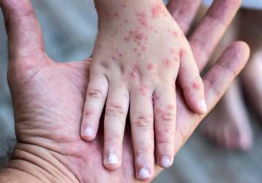 Autoridades de salud en Coahuila reforzaron la vigilancia epidemiológica tras el incremento de casos de sarampión detectados durante el regreso a clases.