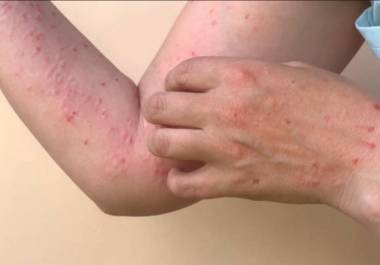 Los casos reportados en el plantel continúan bajo vigilancia mientras se confirma el diagnóstico.