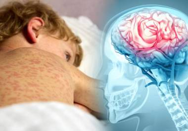 En medio de casos recientes de sarampión en México, expertos alertan sobre sus riesgos y la importancia de la vacunación.