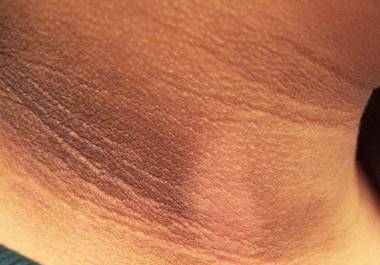 Esta condición, conocida comúnmente como piel oscura o engrosada en el cuello, suele aparecer de forma progresiva