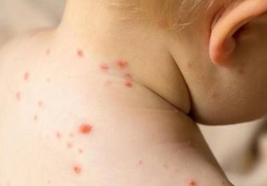 México supera los 9 mil casos de sarampión en 2025, con un incremento notable en varias entidades. La Secretaría de Salud reporta 28 defunciones y refuerza estrategias de prevención ante la expansión del brote.