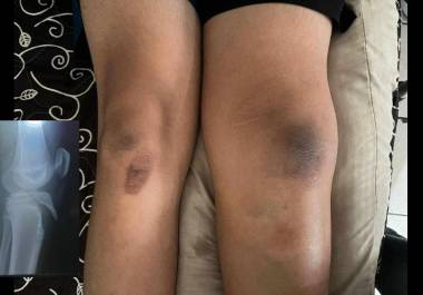 El alumno lesionado fue trasladado por sus padres tras el accidente durante la clase de educación física en el Instituto Bilingüe La Cañada.