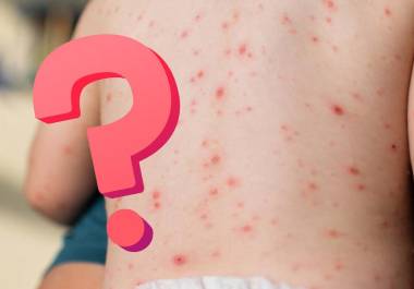 Conoce las diferencias entre sarampión y varicela, sus síntomas, contagio, riesgos y la importancia de la vacunación para prevenir brotes.