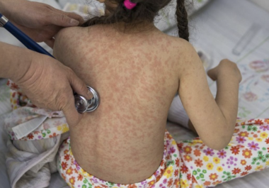 El sarampión es una enfermedad viral altamente contagiosa.