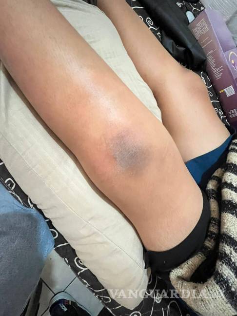 $!La cirugía del estudiante implicó la colocación de tornillos en la tibia, costos que inicialmente cubrieron los tutores.