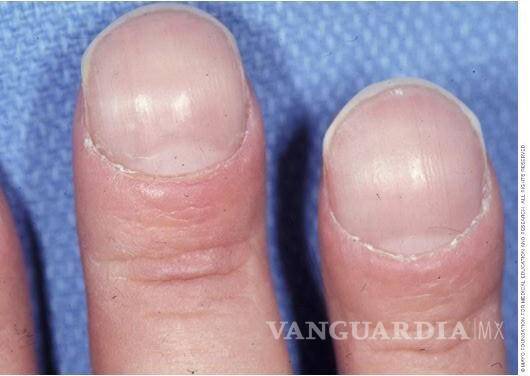 $!‘Clubbing’: tus uñas dan señales de que podrías padecer cáncer. Aquí te contamos cómo identificarlas