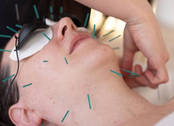 ¿Puede la acupuntura estética ser el nuevo bótox?