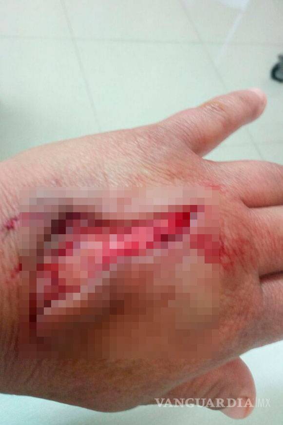 $!En Parras, mujer sufre ataque de perro pitbull