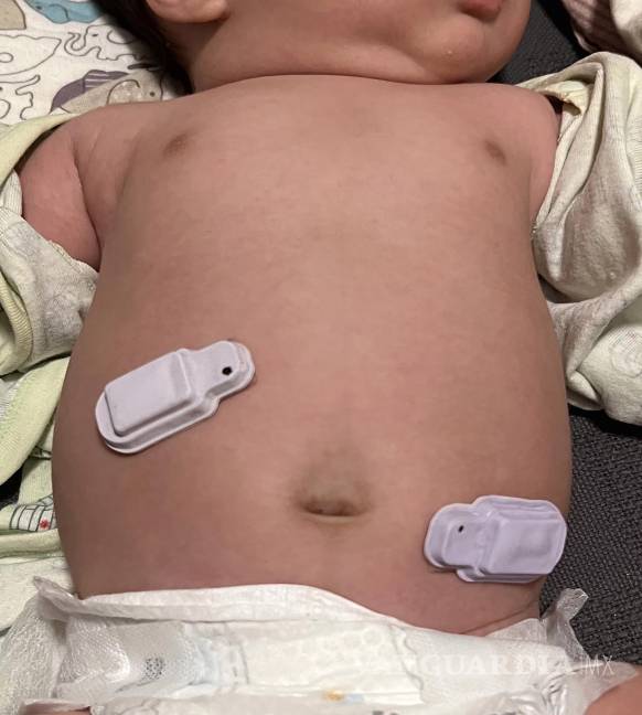 $!Dos dispositivos captando sonidos del tracto gastrointestinal de un bebé prematuro. Foto: Northwestern Medicine.