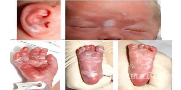 $!En dos años se duplican casos de sífilis en Coahuila; 66 casos en lo que va del 2018