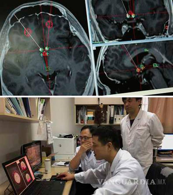 $!Podrían curar a adictos; con electrodos logran 'apagar' las adicciones