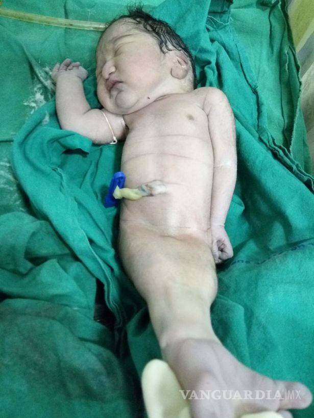 $!Madre da a luz a 'bebé sirena', pero éste muere cuatro horas después