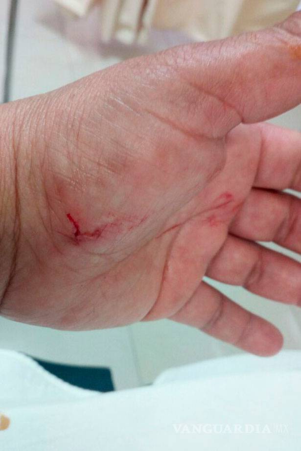 $!En Parras, mujer sufre ataque de perro pitbull