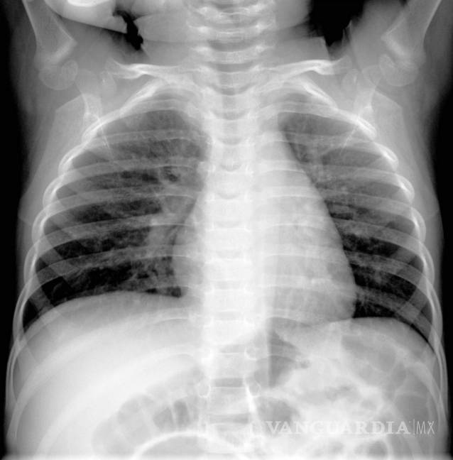 $!Una imagen de rayos X proporcionada por Hilmes et al., Pediatric Radiology, 2017 muestra a un niño de cuatro meses infectado por metapneumovirus humano.