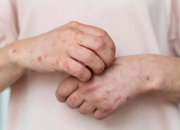 Alerta OMS avance de sarampión en América