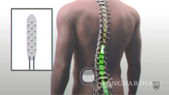 Tres personas parapléjicas recuperan la capacidad de caminar con innovadora terapia