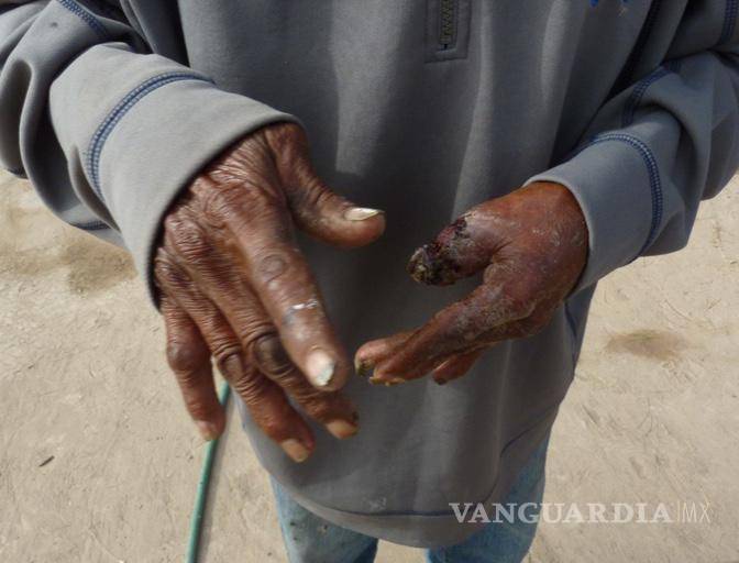 $!Habitantes de La Laguna ya muestran muerte de tejidos por el consumo prolongado de arsénico. Crédito: Jesús Peña/Vanguardia