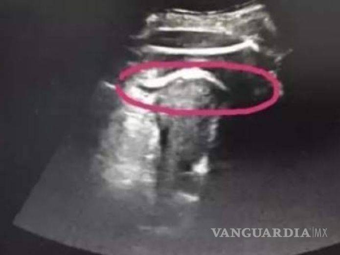 $!De una fuerte patada, bebé perfora útero a su mamá