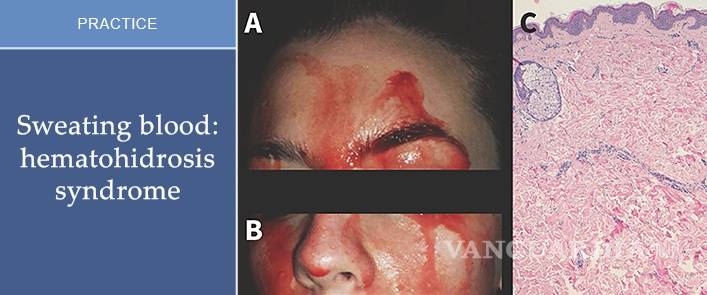 $!Joven italiana que suda sangre por las manos y cara, médicos estudian su caso