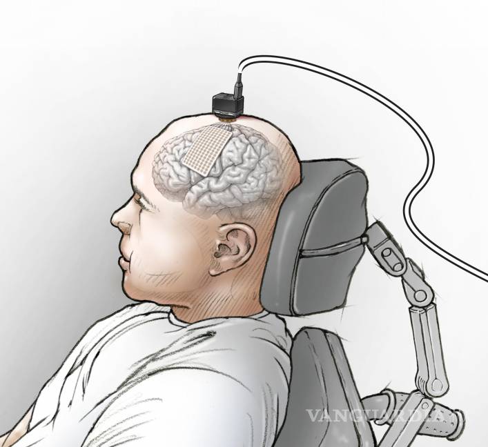 $!Ilustración que muestra la colocación de matriz de electrodos en la corteza motora del habla del participante BRAVO1 y conexión del electrodo a la computadora. Ken Probst/UCSF