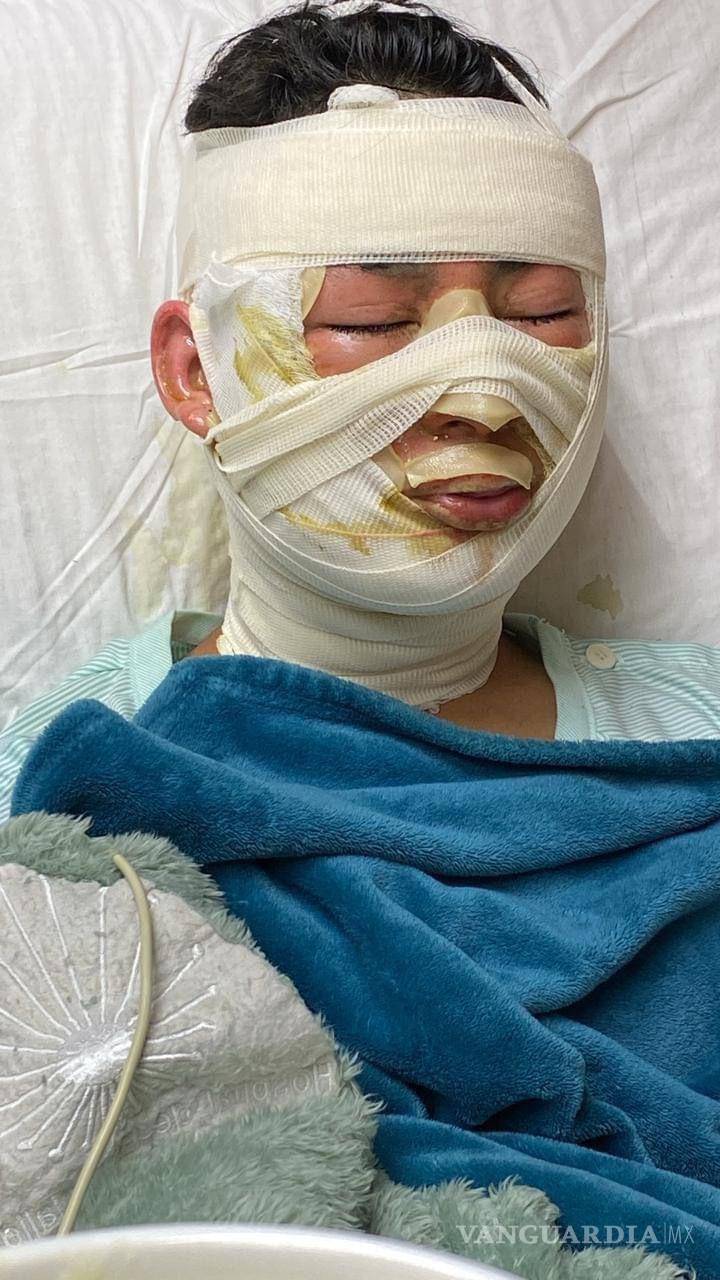 $!El rostro de Daniel muestra las secuelas de la explosión, mientras relata cómo el fuego se extendía por la cocina del restaurante.