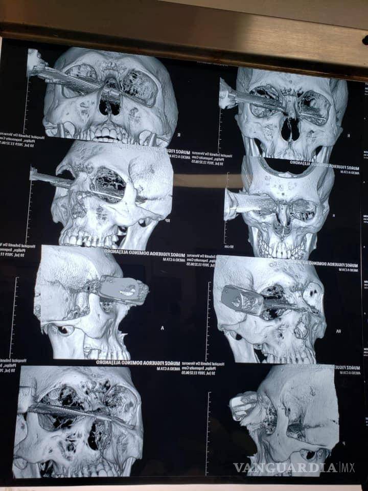 $!Apuñalan a hombre en el ojo tras discusión por cajón de estacionamiento en Veracruz