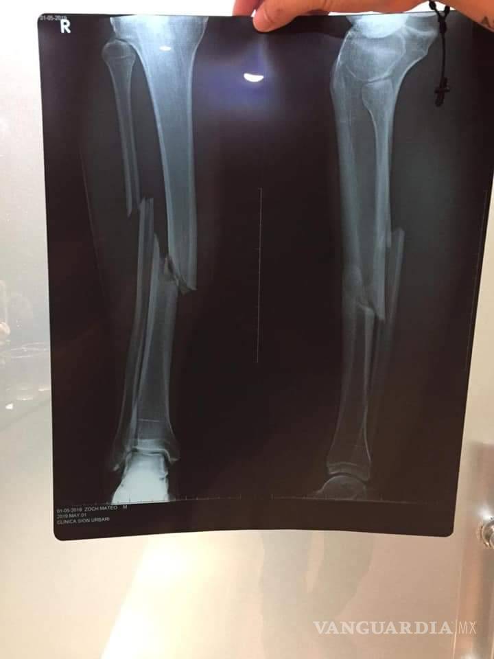 $!La fatal lesión que sufrió un jugador de la Liga de Bolivia tras una 'criminal' entrada