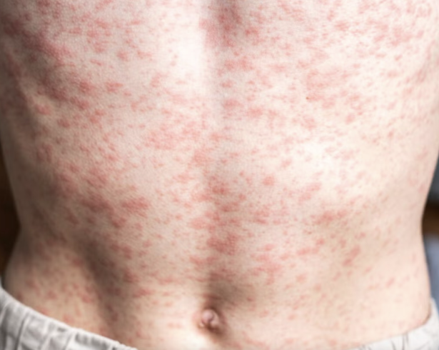 El brote de sarampión en México mantiene en alerta a las autoridades sanitarias.