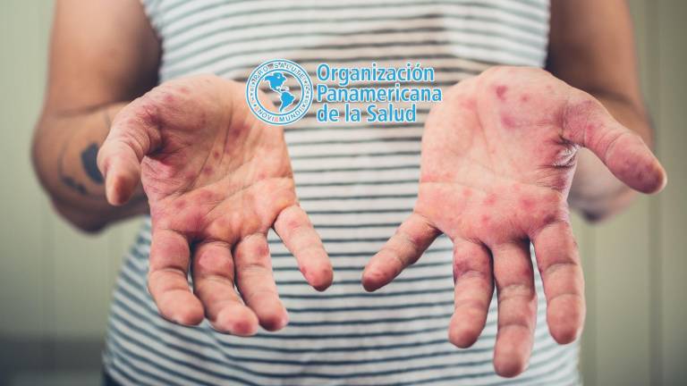 Ante el alza de casos de sarampión, la Organización Panamericana de la Salud (OPS) emitió una nueva alerta epidemiológica en todo América.
