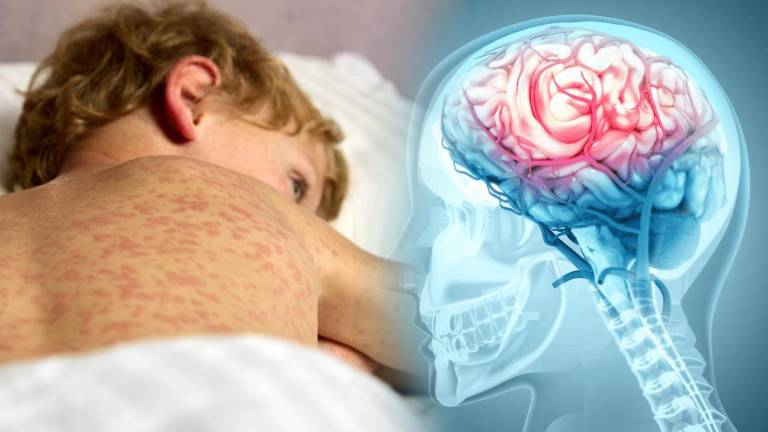 En medio de casos recientes de sarampión en México, expertos alertan sobre sus riesgos y la importancia de la vacunación.