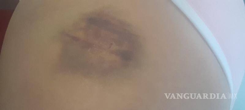 $!La afectada presentó heridas visibles tras la agresión por parte de un empleado de la taquería.