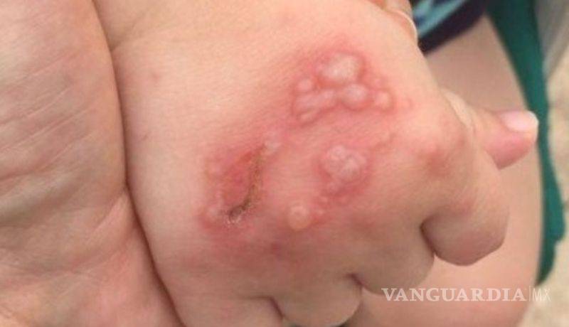 $!Brote de virus Coxsackie pone en alerta a siete estados