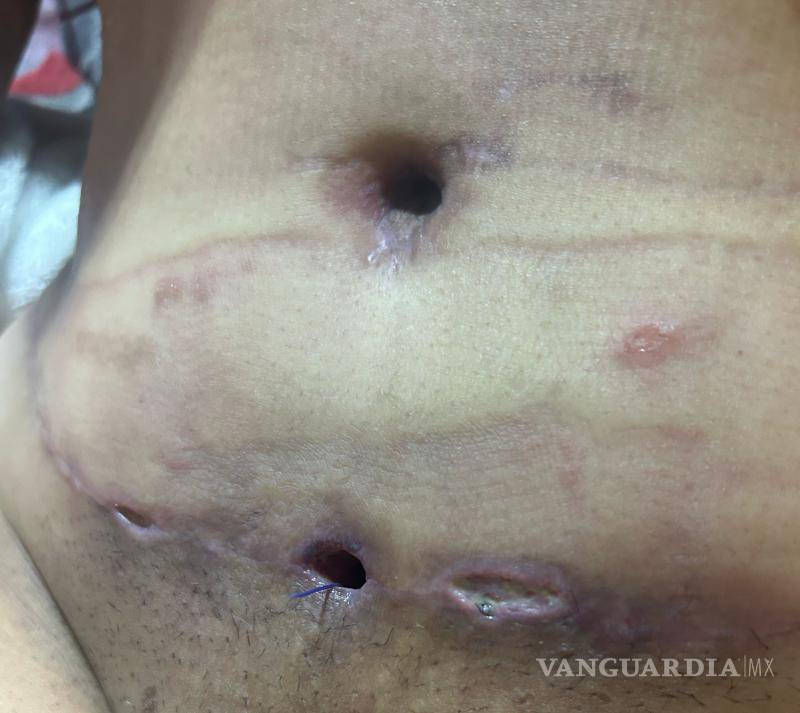 $!La joven relata cómo el dolor y las complicaciones la afectaron emocionalmente durante su recuperación.