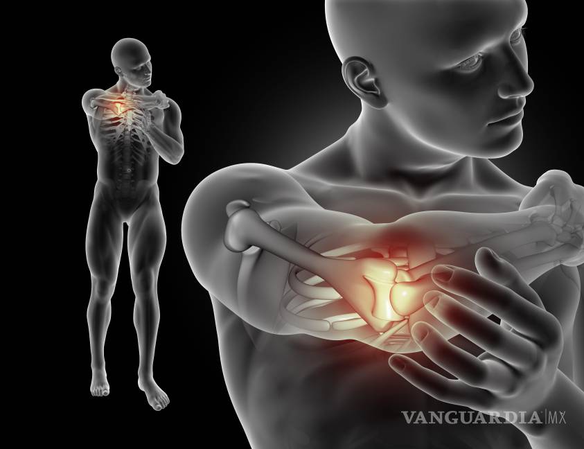 $!Durante mucho tiempo, la gota fue vista como una enfermedad del pasado o asociada únicamente a excesos alimenticios.